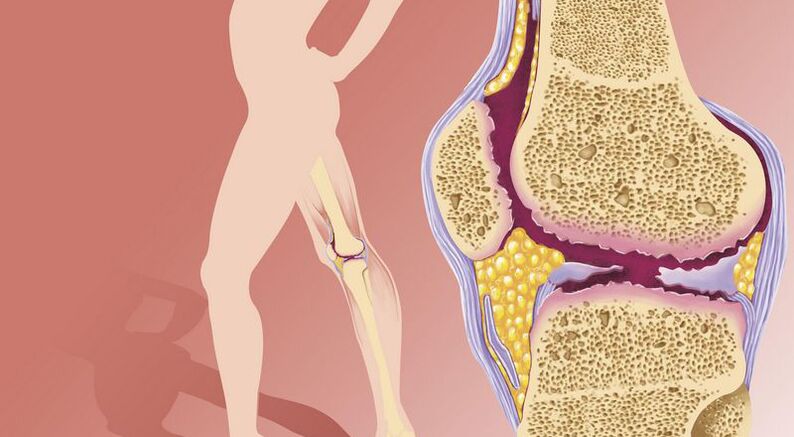 El sobrepeso provoca osteoartritis